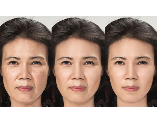 medical spa rx Study Finds Best Filler for Chinese Patients