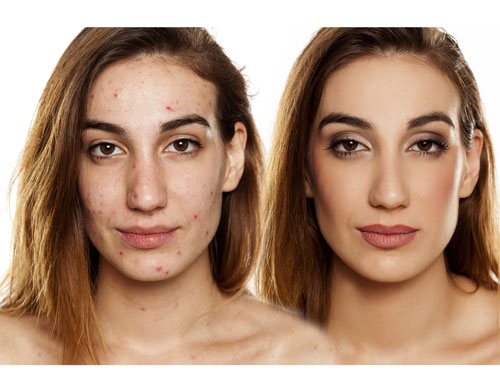 medical spa rx Professional Tips: Treat Acne Scarring with Dermal Fillers Introduction