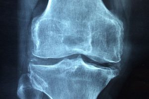 medical spa rx Supartz vs Synvisc: Which viscosupplement should I use?