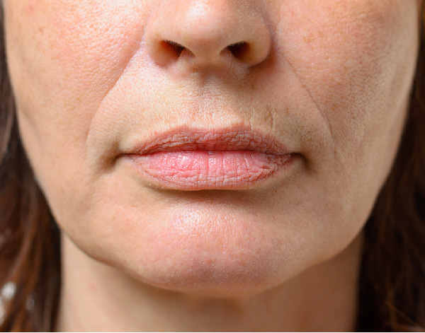 medical spa rx How to Treat the Perioral Area