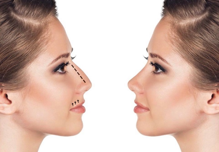 medical spa rx Nonsurgical Rhinoplasty: What You Need to Know